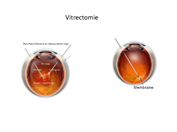 Vitrectomie 