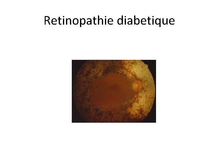 Retinopathie diabetique 