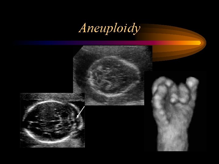 Aneuploidy 