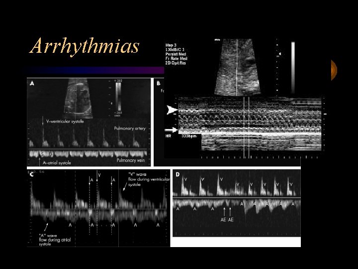 Arrhythmias 