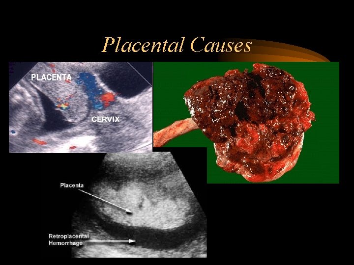 Placental Causes Placental Causes