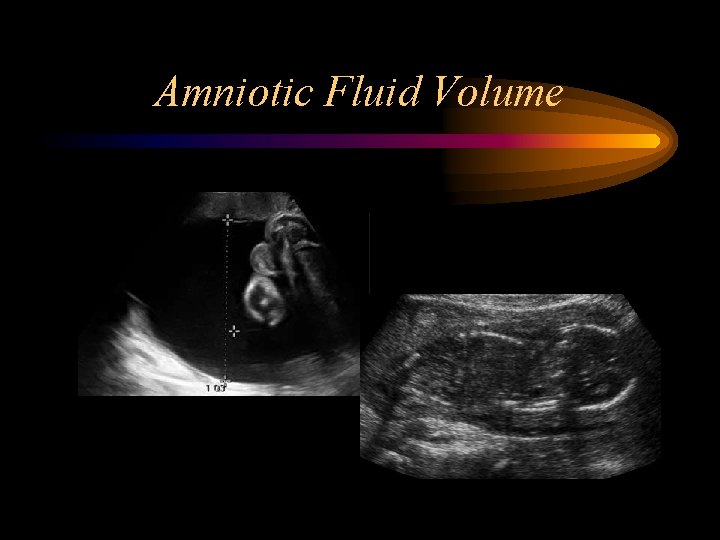 Amniotic Fluid Volume 