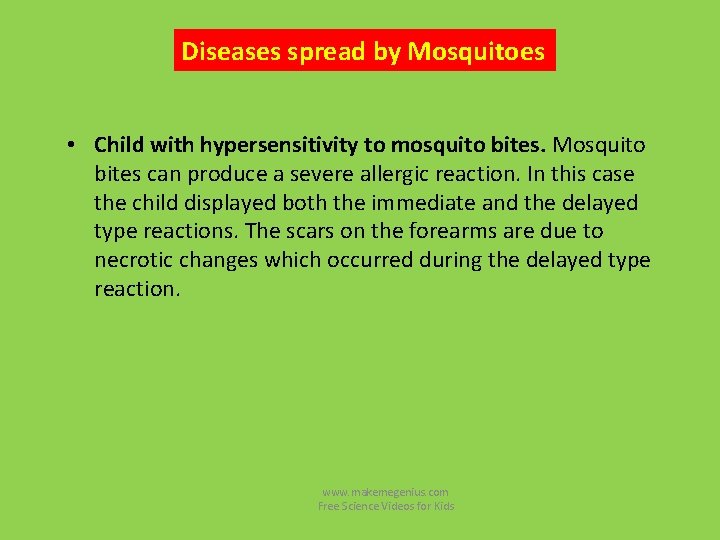 Diseases spread by Mosquitoes • Child with hypersensitivity to mosquito bites. Mosquito bites can Diseases spread by Mosquitoes • Child with hypersensitivity to mosquito bites. Mosquito bites can