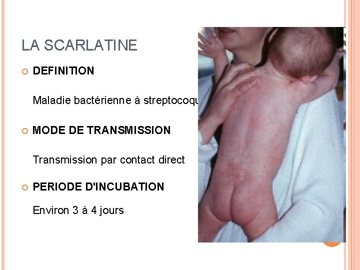 LA SCARLATINE DEFINITION Maladie bactérienne à streptocoques. MODE DE TRANSMISSION Transmission par contact direct