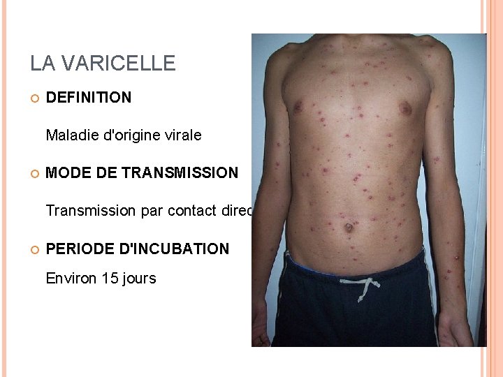 LA VARICELLE DEFINITION Maladie d'origine virale MODE DE TRANSMISSION Transmission par contact direct PERIODE