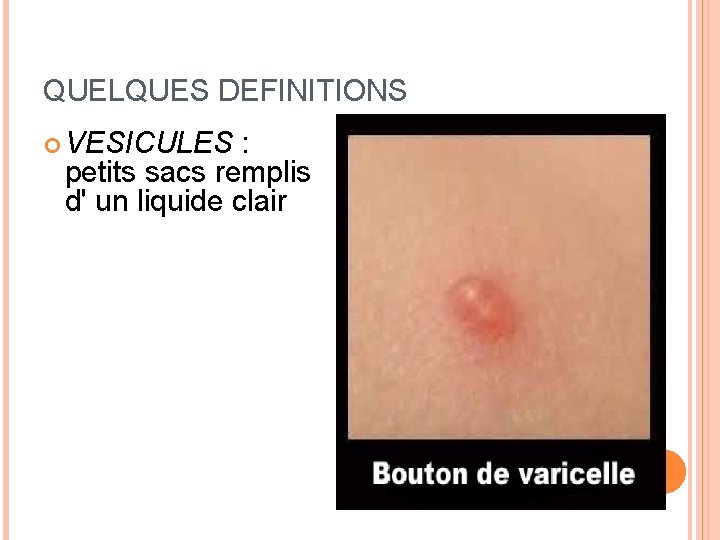 QUELQUES DEFINITIONS VESICULES : petits sacs remplis d' un liquide clair 