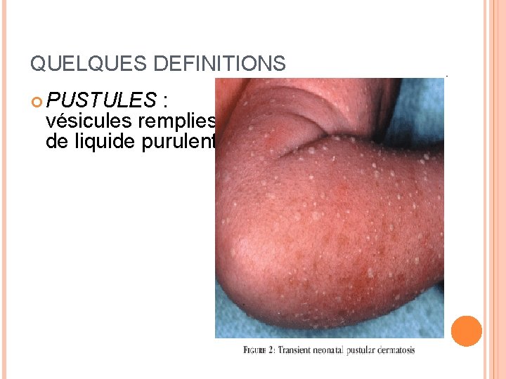 QUELQUES DEFINITIONS PUSTULES : vésicules remplies de liquide purulent 