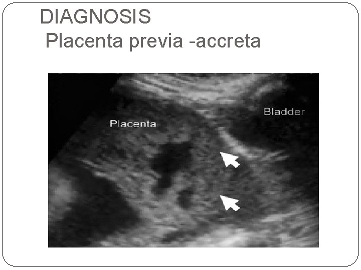 DIAGNOSIS Placenta previa -accreta 