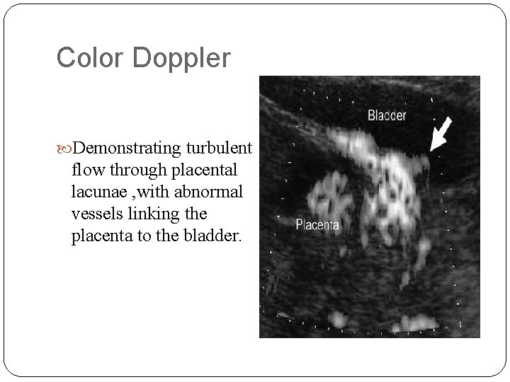 Color Doppler Demonstrating turbulent flow through placental lacunae , with abnormal vessels linking the