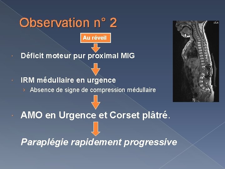 Observation n° 2 Au réveil Déficit moteur proximal MIG IRM médullaire en urgence ›