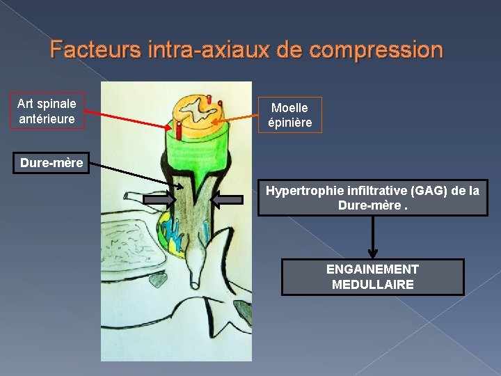 Facteurs intra-axiaux de compression Art spinale antérieure Moelle épinière Dure-mère Hypertrophie infiltrative (GAG) de