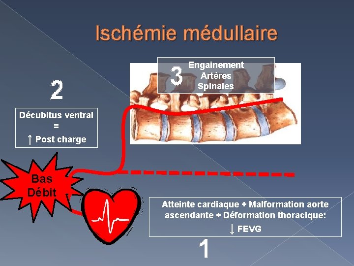 Ischémie médullaire 2 3 Engainement Artères Spinales Décubitus ventral = ↑ Post charge Bas