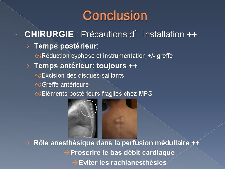 Conclusion CHIRURGIE : Précautions d’installation ++ › Temps postérieur: Réduction cyphose et instrumentation +/-