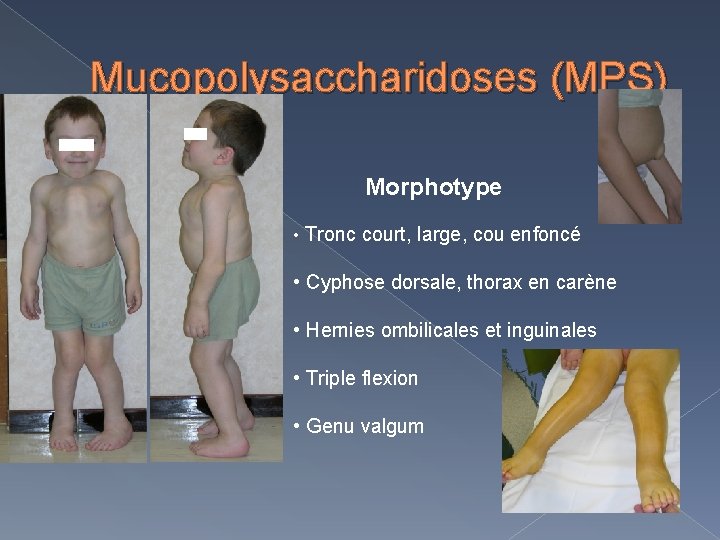 Mucopolysaccharidoses (MPS) Morphotype • Tronc court, large, cou enfoncé • Cyphose dorsale, thorax en