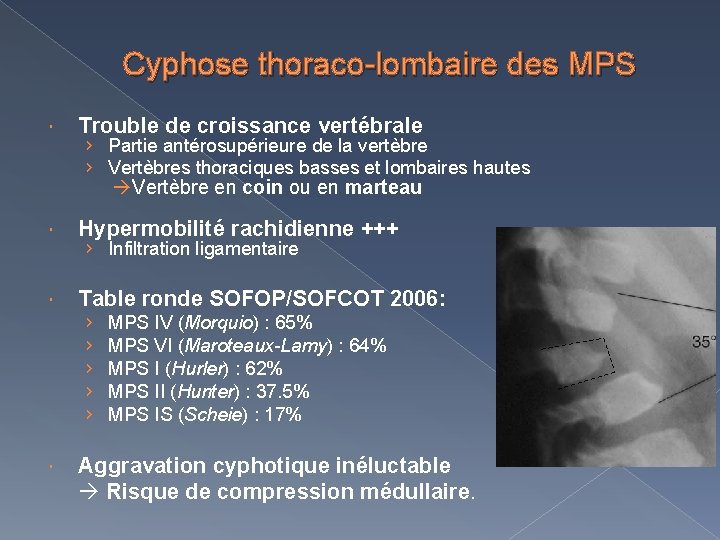 Cyphose thoraco-lombaire des MPS Trouble de croissance vertébrale › Partie antérosupérieure de la vertèbre