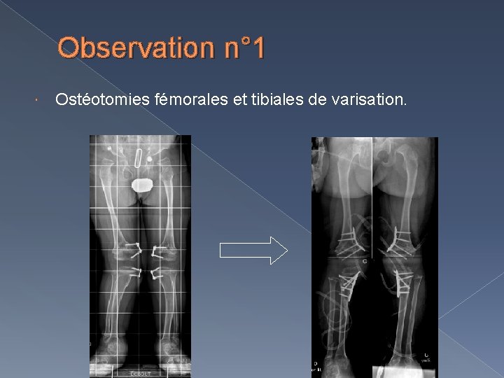Observation n° 1 Ostéotomies fémorales et tibiales de varisation. 