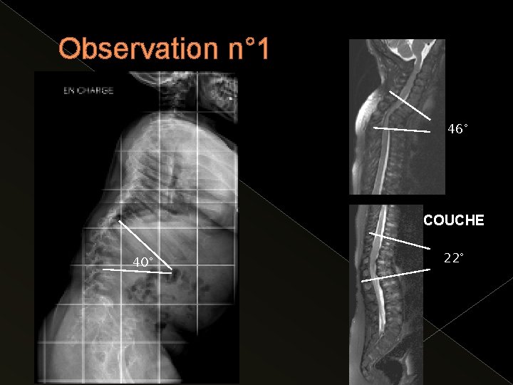 Observation n° 1 46° DEBOUT COUCHE 40° 22° Observation n° 1 46° DEBOUT COUCHE 40° 22°