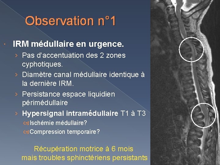 Observation n° 1 IRM médullaire en urgence. › Pas d’accentuation des 2 zones cyphotiques.