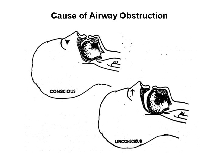 Cause of Airway Obstruction 