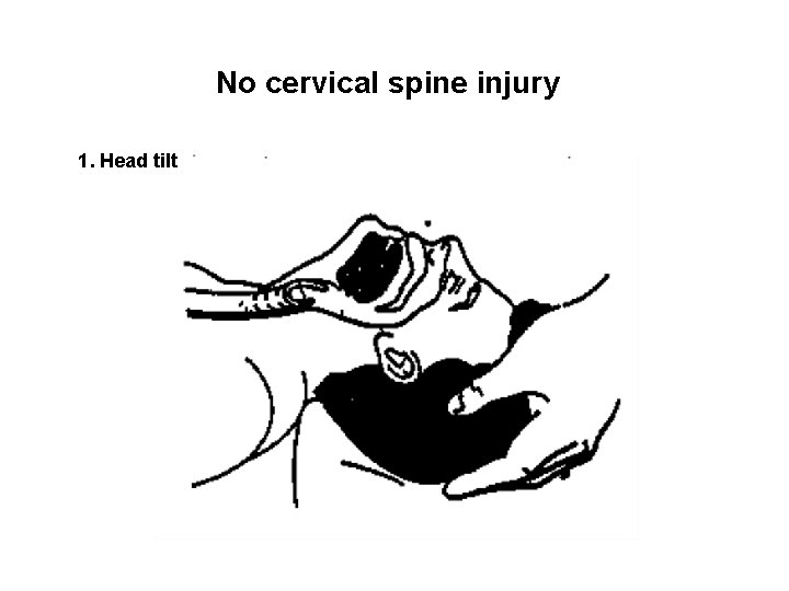 No cervical spine injury 1. Head tilt 