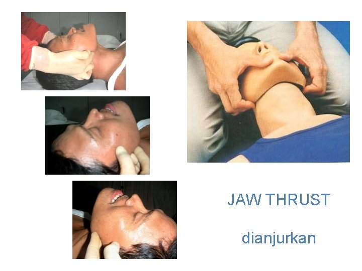 JAW THRUST dianjurkan 