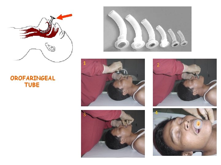 1 2 OROFARINGEAL TUBE 3 4 