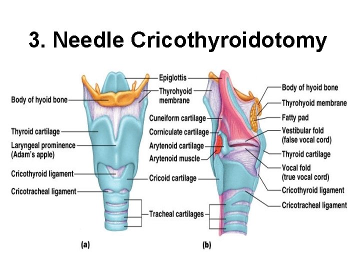 3. Needle Cricothyroidotomy 
