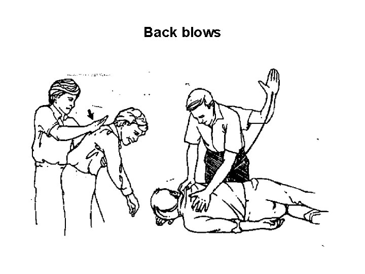 Back blows 