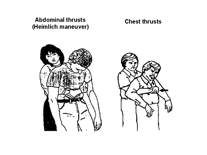Abdominal thrusts (Heimlich maneuver) Chest thrusts 
