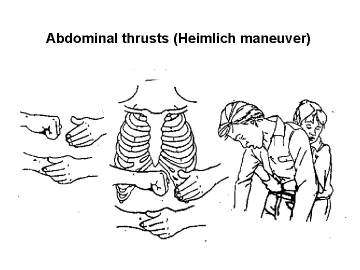 Abdominal thrusts (Heimlich maneuver) 