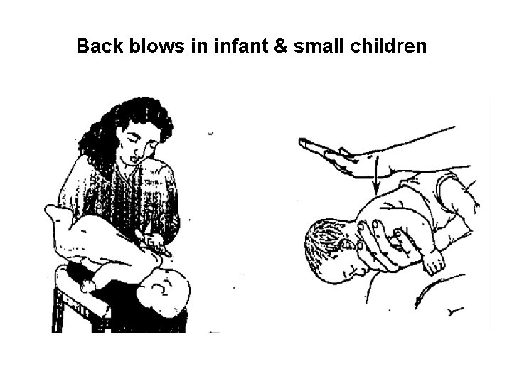 Back blows in infant & small children 