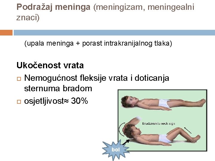Podražaj meninga (meningizam, meningealni znaci) (upala meninga + porast intrakranijalnog tlaka) Ukočenost vrata Nemogućnost