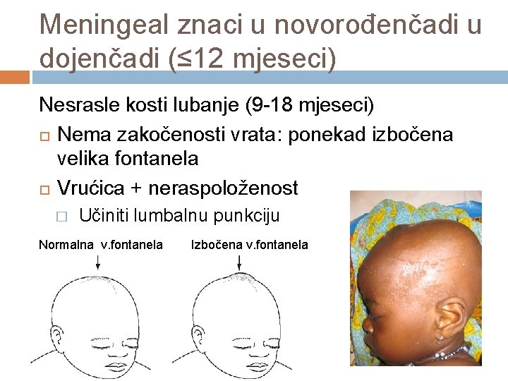 Meningeal znaci u novorođenčadi u dojenčadi (≤ 12 mjeseci) Nesrasle kosti lubanje (9 -18