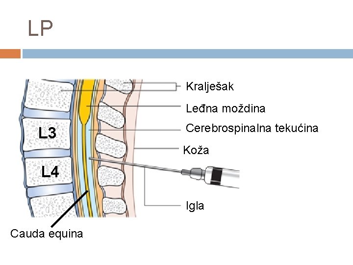 LP Kralješak Leđna moždina L 3 Cerebrospinalna tekućina Koža L 4 Igla Cauda equina