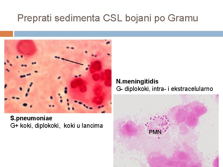 Preprati sedimenta CSL bojani po Gramu N. meningitidis G- diplokoki, intra- i ekstracelularno S.
