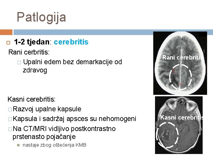 Patlogija 1 -2 tjedan: cerebritis Rani cerbritis: cerbritis � Upalni edem bez demarkacije od