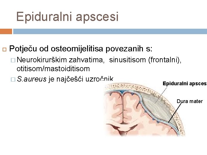 Epiduralni apscesi Potječu od osteomijelitisa povezanih s: � Neurokirurškim zahvatima, sinusitisom (frontalni), otitisom/mastoiditisom �