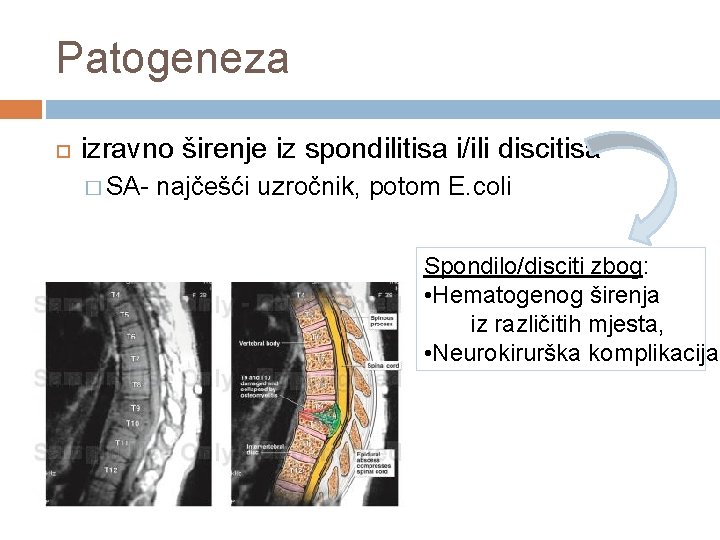 Patogeneza izravno širenje iz spondilitisa i/ili discitisa � SA- najčešći uzročnik, potom E. coli