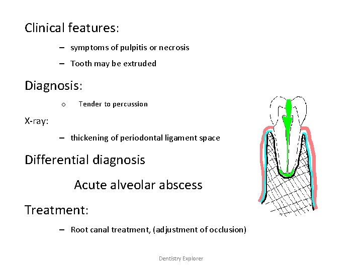 Clinical features: – symptoms of pulpitis or necrosis – Tooth may be extruded Diagnosis: