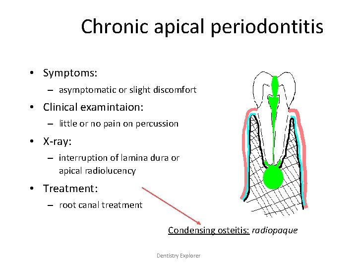 Chronic apical periodontitis • Symptoms: – asymptomatic or slight discomfort • Clinical examintaion: –