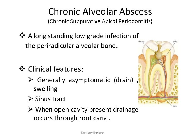 Chronic Alveolar Abscess (Chronic Suppurative Apical Periodontitis) v A long standing low grade infection