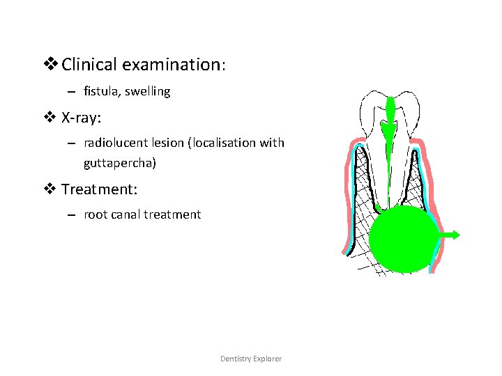 v Clinical examination: – fistula, swelling v X-ray: – radiolucent lesion (localisation with guttapercha)