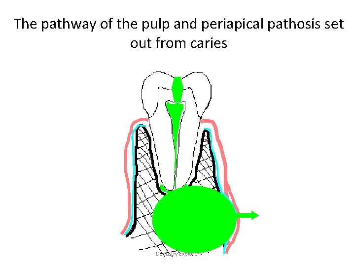 The pathway of the pulp and periapical pathosis set out from caries Dentistry Explorer