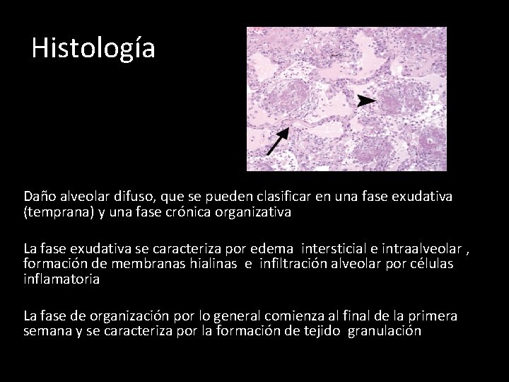 Histología Daño alveolar difuso, que se pueden clasificar en una fase exudativa (temprana) y