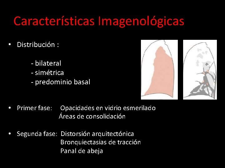 Características Imagenológicas • Distribución : - bilateral - simétrica - predominio basal • Primer