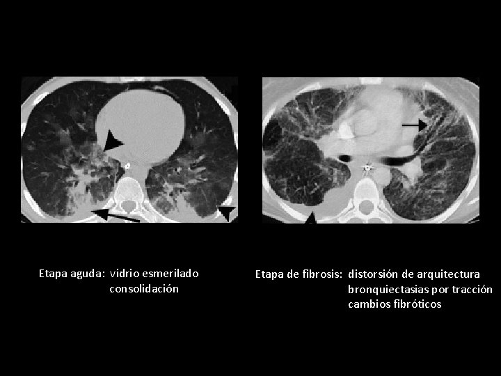 Etapa aguda: vidrio esmerilado consolidación Etapa de fibrosis: distorsión de arquitectura bronquiectasias por tracción