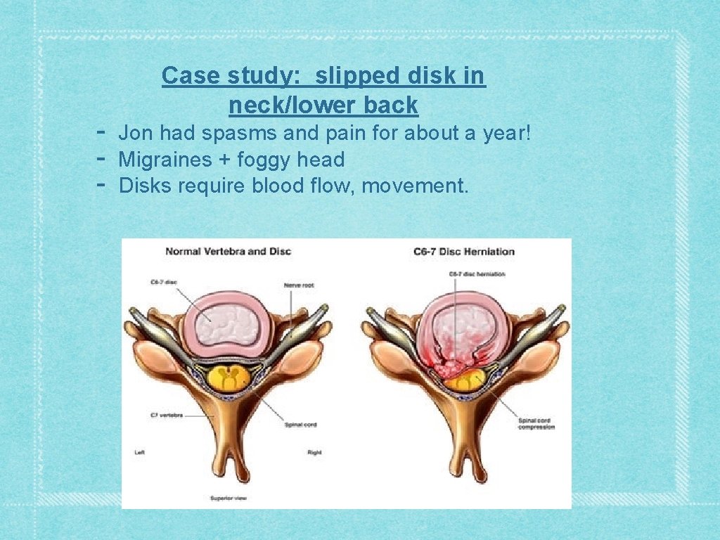 - Case study: slipped disk in neck/lower back Jon had spasms and pain for