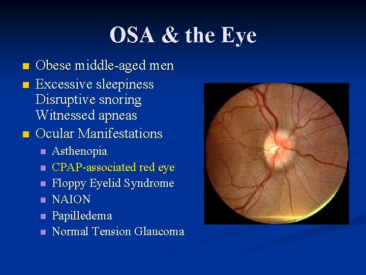 OSA & the Eye n n n Obese middle-aged men Excessive sleepiness Disruptive snoring