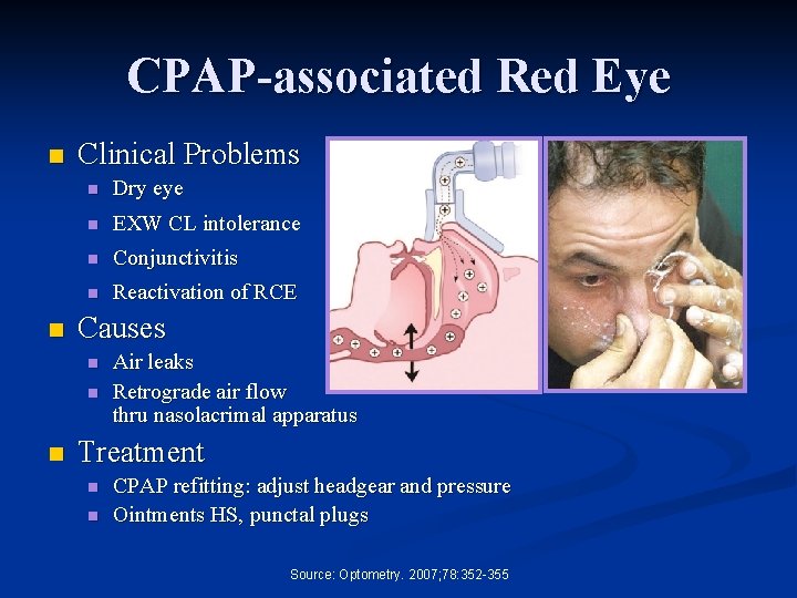 CPAP-associated Red Eye n n Clinical Problems n Dry eye n EXW CL intolerance