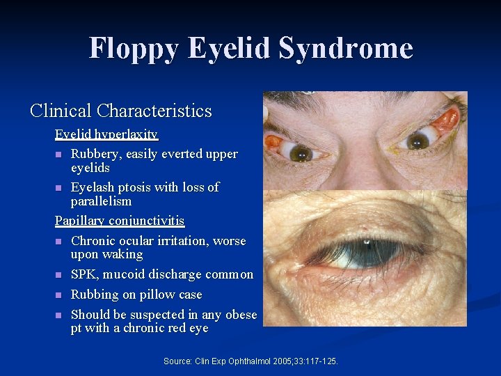 Floppy Eyelid Syndrome Clinical Characteristics Eyelid hyperlaxity n Rubbery, easily everted upper eyelids n